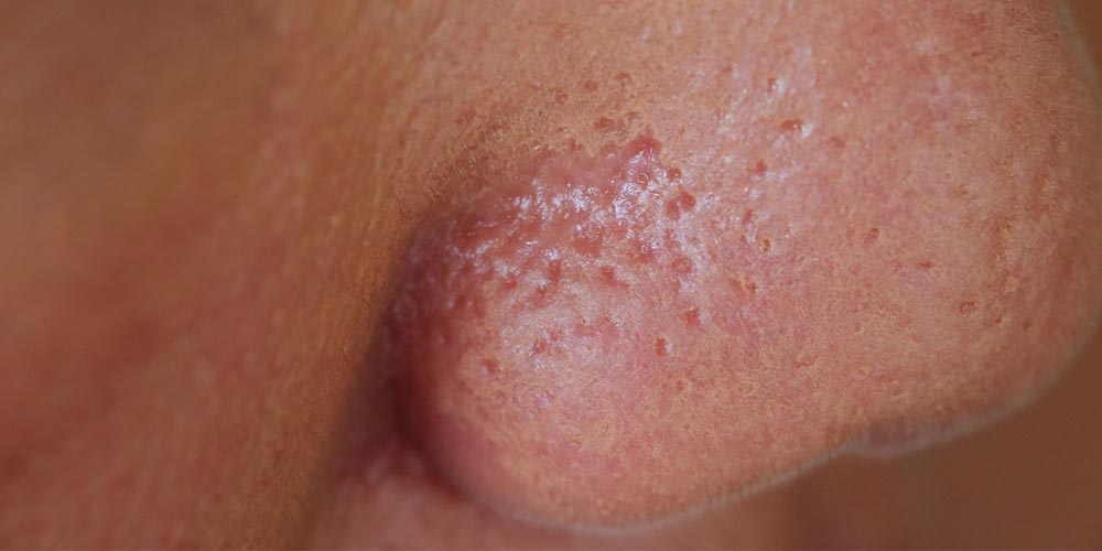 Pores are nothing but skin holes. There are hair follicles underneath the upper layer of our skin and when hair grows up, it comes out of the skin and creates a small hole which is about 0.02mm to 0.05mm. It’s absolutely very tiny.